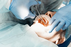 Dental Implant Placement