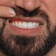 Inflamed Gums Man