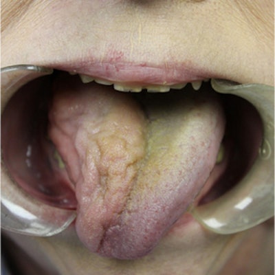 The woman's tongue shows right-sided atrophy and mild right-sided deviation. Image courtesy of Scott et al. Licensed by CC BY 4.0.
