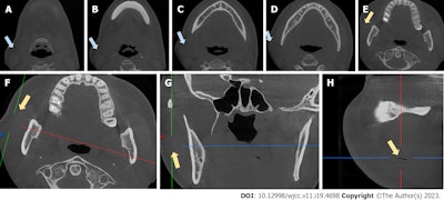 Coronal views of CBCT scans (A-E) show swelling. The CBCT scan shows an air-filled fissure between the masseter muscle and soft tissue (F-H) . The blue arrows indicate swelling, while the yellow arrows indicate the fissure. Images courtesy of Sun et al. Licensed by CC BY 4.0.