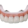 SprintRay's 3D-printed, fixed, implant-supported denture using OnX Tough 2. Image courtesy of SprintRay.