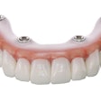 SprintRay's 3D-printed, fixed, implant-supported denture using OnX Tough 2. Image courtesy of SprintRay.