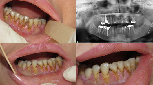 Diffuse gingival ulceration and recession. An orthopantogram showed multiple previous dental fillings and root canal treatment to control her pain. Image courtesy of Yazan Hassona.