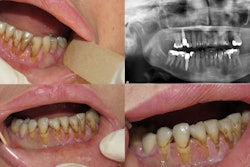 Diffuse gingival ulceration and recession. An orthopantogram showed multiple previous dental fillings and root canal treatment to control her pain. Image courtesy of Yazan Hassona.