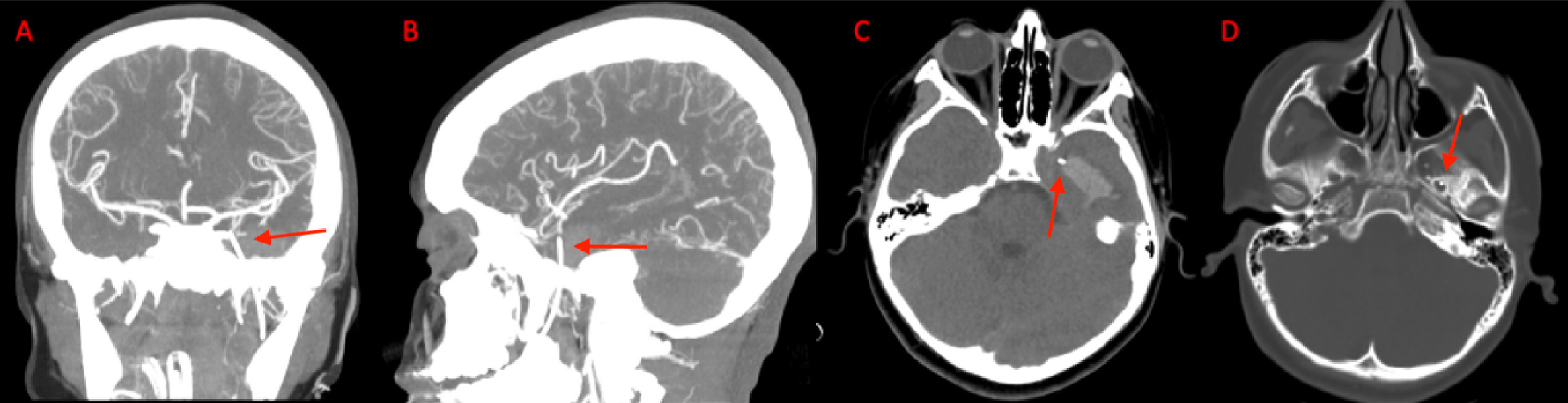 A coronal (A) and sagittal (B) view of the CT angiogram shows the wire penetrating through the skull floor of a 12-year-old boy. (C) An axial view of CT demonstrates the wire in the temporal lobe and the associated intraparenchymal hemorrhage. (D) Axial bone window CT shows the wire entering through the foramen ovale. Images courtesy of Morgan et al. Licensed by CC BY 4.0.