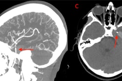 A coronal (A) and sagittal (B) view of the CT angiogram shows the wire penetrating through the skull floor of a 12-year-old boy. (C) An axial view of CT demonstrates the wire in the temporal lobe and the associated intraparenchymal hemorrhage. (D) Axial bone window CT shows the wire entering through the foramen ovale. Images courtesy of Morgan et al. Licensed by CC BY 4.0.