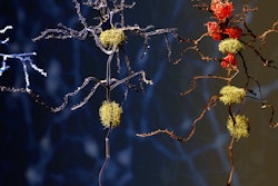 Alzheimers Phases Amyloid (1)