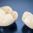 Dental Crowns