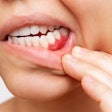 Gum Inflammation