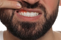 Inflamed Gums Man