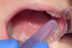 The mock 3TBA handpiece inserted into a full-arch 3TBA guide as part of a pilot human trial. Image courtesy of TriAgenics.