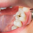 Dental Caries
