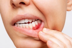 Gum Inflammation