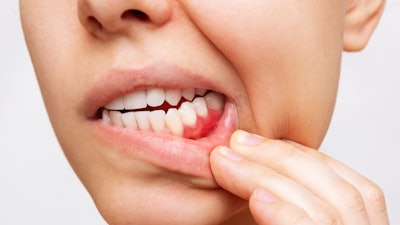 Gum Inflammation