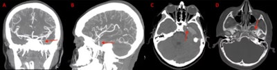 (A) and (B) Coronal and sagittal view of the CT angiogram shows the wire penetrating through the skull floor of a 12-year-old boy. (C) Axial view of CT demonstrates the wire in the temporal lobe and the associated intraparenchymal hemorrhage. (D) Axial bone window CT shows the wire entering through the foramen ovale. Images courtesy of Morgan et al. Licensed by CC BY 4.0.
