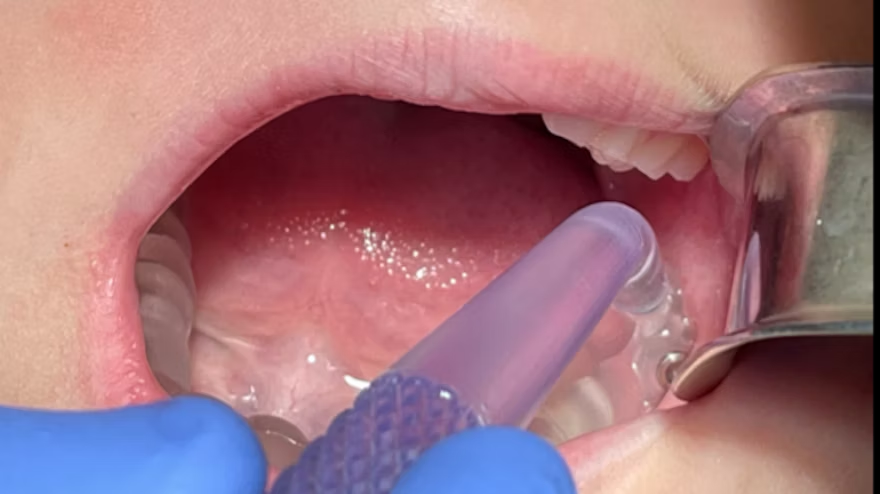 The mock 3TBA handpiece inserted into a full-arch 3TBA guide as part of a pilot human trial. Image courtesy of TriAgenics.