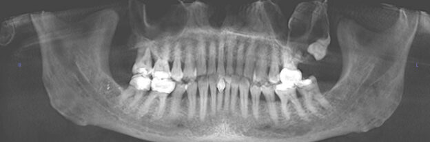 A 39-year-old man with tooth displacement. All images courtesy of Dr. Juan Yepes, MPH, DrPH.