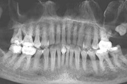 A 39-year-old man with tooth displacement. All images courtesy of Dr. Juan Yepes, MPH, DrPH.