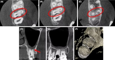 (A-C) Axial CBCT images in the cervical, middle, and apical region of the man’s molar. (D) The coronal section showed the apical split of roots and early periapical radiolucency in the palatal root (red arrow). (E) The sagittal section shows the gouging of the floor. Images courtesy of Marya et al. Licensed by CC BY 4.0.