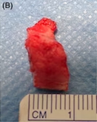 A (B) clinical image of the resected lesion. Image courtesy of Pedersen et al. Licensed by CC BY 4.0.