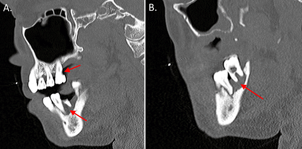 (A) A CT scan with contrast shows the sagittal view of the man's endodontic and periodontal disease of the right teeth (red arrows). (B) A CT scan with contrast shows the sagittal view of the patient's periodontal disease of the left teeth (arrow). Images courtesy of Munoz et al. Licensed by CC BY 4.0.