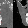(A) A CT scan with contrast shows the sagittal view of the man's endodontic and periodontal disease of the right teeth (red arrows). (B) A CT scan with contrast shows the sagittal view of the patient's periodontal disease of the left teeth (arrow). Images courtesy of Munoz et al. Licensed by CC BY 4.0.
