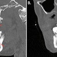 (A) A CT scan with contrast shows the sagittal view of the man's endodontic and periodontal disease of the right teeth (red arrows). (B) A CT scan with contrast shows the sagittal view of the patient's periodontal disease of the left teeth (arrow). Images courtesy of Munoz et al. Licensed by CC BY 4.0.