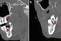 (A) A CT scan with contrast shows the sagittal view of the man's endodontic and periodontal disease of the right teeth (red arrows). (B) A CT scan with contrast shows the sagittal view of the patient's periodontal disease of the left teeth (arrow). Images courtesy of Munoz et al. Licensed by CC BY 4.0.