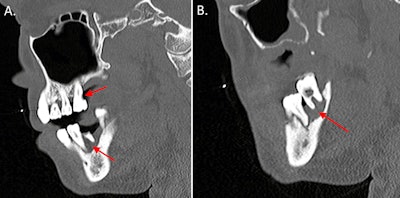 (A) A CT scan with contrast shows the sagittal view of the man's endodontic and periodontal disease of the right teeth (red arrows). (B) A CT scan with contrast shows the sagittal view of the patient's periodontal disease of the left teeth (arrow). Images courtesy of Munoz et al. Licensed by CC BY 4.0.