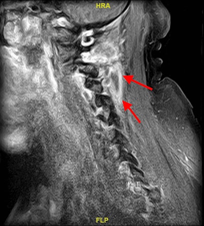 An MRI with contrast of the man’s cervical spine revealed a soft-tissue lesion likely reflecting an abscess with surrounding edema and enhancement (red arrows).
