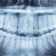 Panoramic Xray