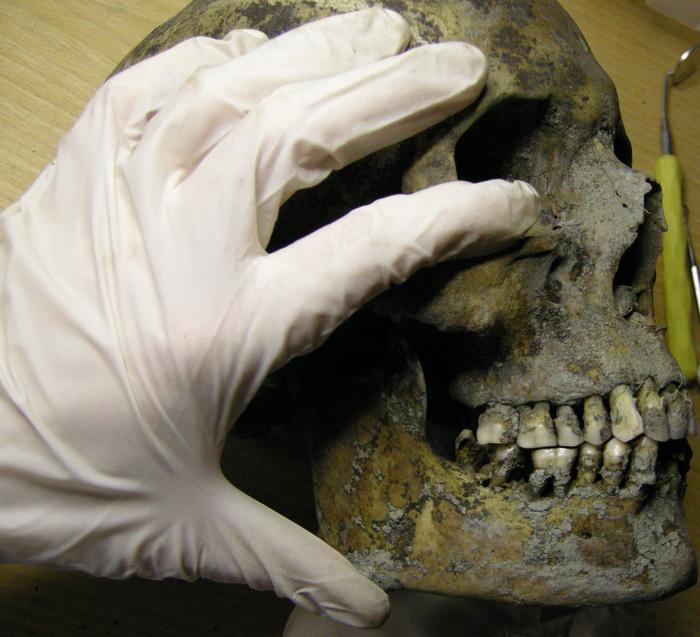 Examination of Viking jaw and teeth. Image courtesy of Carolina Bertilsson, CC-BY 4.0.