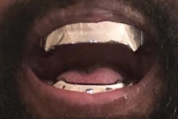 Ye's new titanium dentures. Image courtesy of Ye/Instagram.