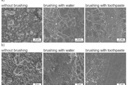 After drinking pure black tea (a) during CHX treatment, significantly stronger staining can be seen under the scanning electron microscope in comparison to drinking the beverage diluted with milk (b). Images and caption courtesy of Fraunhofer IMWS/Haleon.