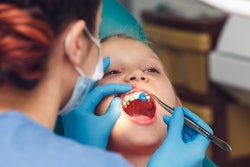 Child Fluoride Application