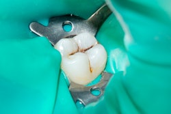 Root Canal Carious Tooth