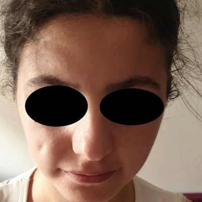 There was a significant reduction of the facial dimple on the skin surface seven days postoperatively.