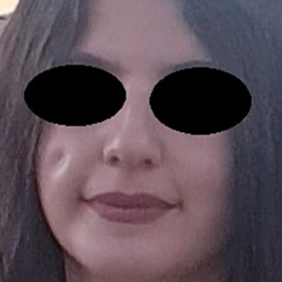 Asymptomatic decrease on the facial skin surface without any pigmentation or pus. All images courtesy of Mahlobi et al/Int J Surg Case Rep.