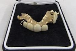 Partial upper gold-mounted denture designed for Sir Winston Churchill. Image courtesy of the Cotswold Auction Company.