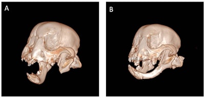 These 3D scans of Tyson show his removed jaw immediately after surgery (left) and eight weeks afterward (right) with the regrown mandible.
