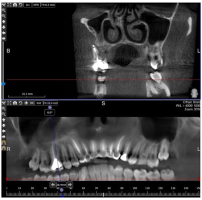 A cone-beam computed tomography scan showing a bony defect at the apex of mesiobuccal root of the upper first molar.