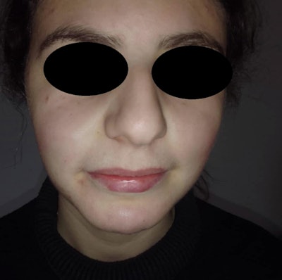 A frontal view confirms full healing six months postoperatively.