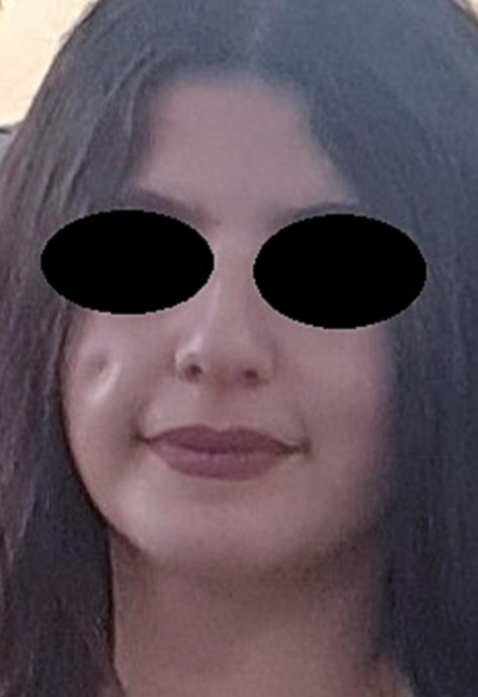 Asymptomatic decrease on the facial skin surface without any pigmentation or pus. All images courtesy of Mahlobi et al/Int J Surg Case Rep.