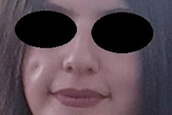 Asymptomatic decrease on the facial skin surface without any pigmentation or pus. All images courtesy of Mahlobi et al/Int J Surg Case Rep.