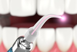 Dental Laser