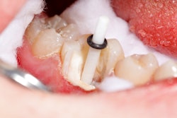 Tooth Filling