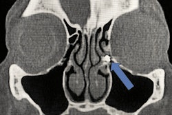 Metal foreign body in the ethmoid infundibulum. Image courtesy of Kramer et al. Licensed under CC BY 4.0.
