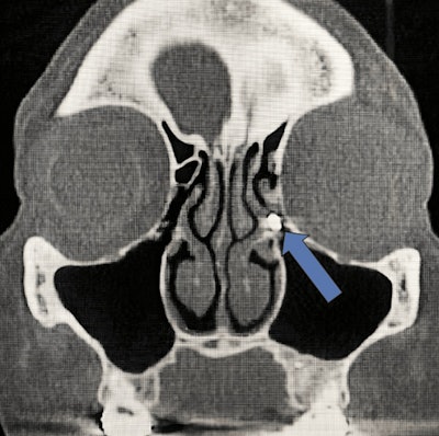 Metal foreign body in the ethmoid infundibulum. Image courtesy of Kramer et al. Licensed under CC BY 4.0.