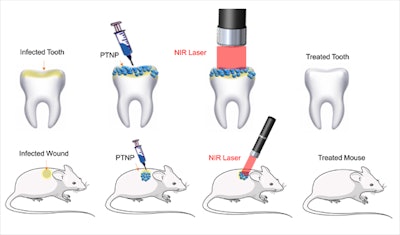 In the study, gold nanoparticles delivered to infected teeth and skin wounds are heated with near infrared lasers to destroy biofilms. Images and captions courtesy of Hajfathalian et al. Licensed under CC BY 4.0.