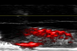 Researchers were able to visualize biofilms in teeth treated with dextran-coated gold nanoparticles using photoacoustic imaging.